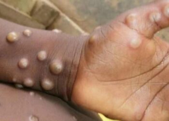 Маймыл шешегі дендеп тұр: Халықаралық деңгейде төтенше жағдай жарияланды