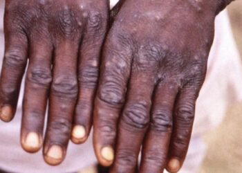 Маймыл шешегі: Министрлік Қазақстандағы ахуалды айтты