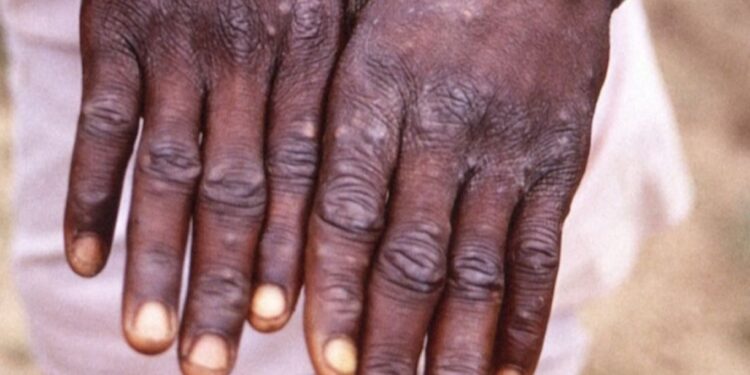 Маймыл шешегі: Министрлік Қазақстандағы ахуалды айтты