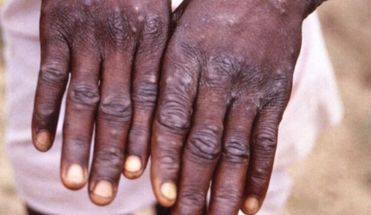 Маймыл шешегі: Министрлік Қазақстандағы ахуалды айтты