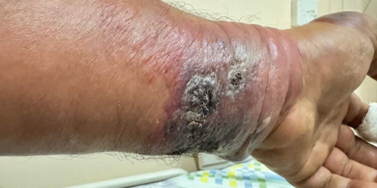 В Алматинской области произошла вспышка сибирской язвы: два человека госпитализированы