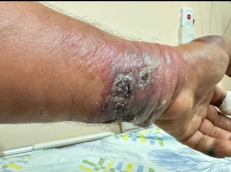 В Алматинской области произошла вспышка сибирской язвы: два человека госпитализированы