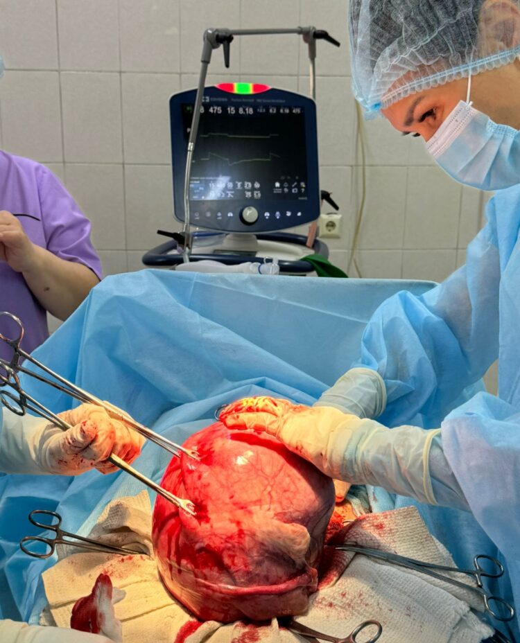 В Алматы врачи удалили 6-килограммовую миому матки у пациентки