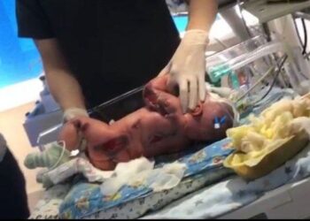 В роддоме Семея младенец получил серьезные ожоги