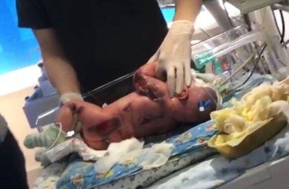 В роддоме Семея младенец получил серьезные ожоги