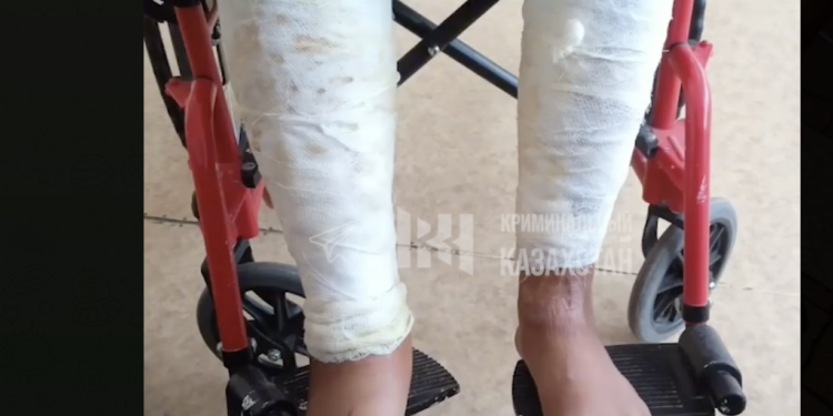 В Карагандинской области подросток поджег сверстника, облитого бензином