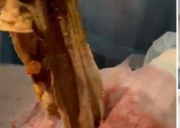 9 ай бойы ішінде дәке болған: алматылық әйел дәрігерлердің қателігінен ішексіз қалды