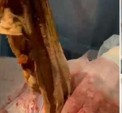 9 ай бойы ішінде дәке болған: алматылық әйел дәрігерлердің қателігінен ішексіз қалды