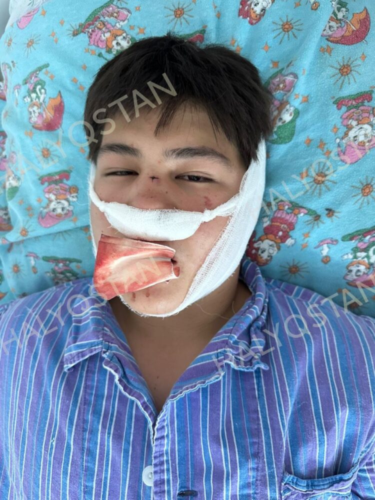 Кызылорда: школьника избили до открытого перелома, полиция затягивает расследование