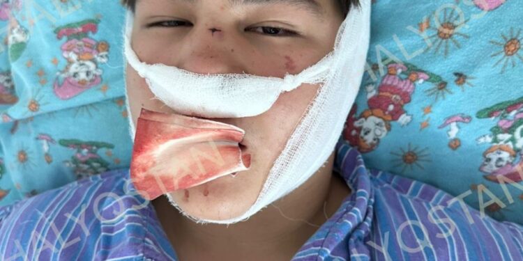 Кызылорда: школьника избили до открытого перелома, полиция затягивает расследование