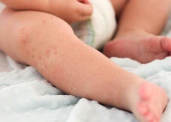 В Астане детей будут госпитализировать только после вакцинации от кори