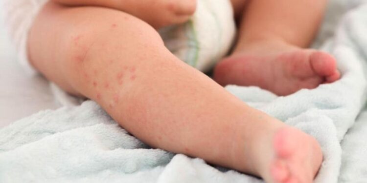 В Астане детей будут госпитализировать только после вакцинации от кори