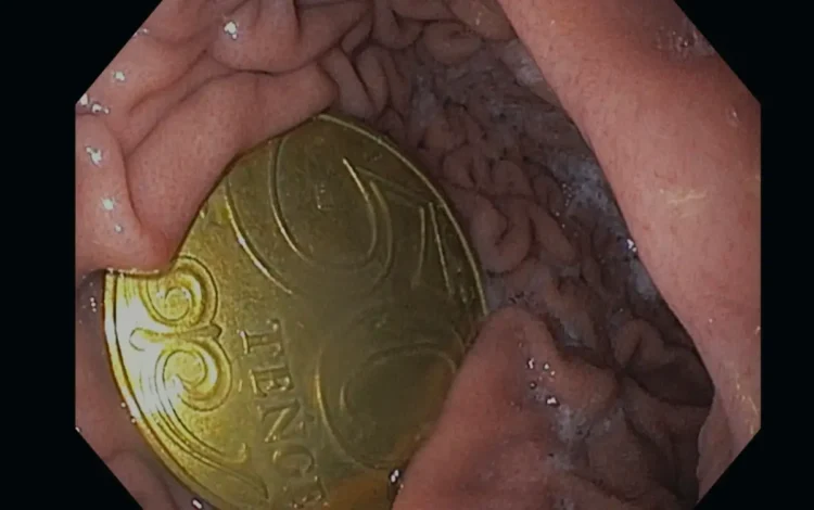 Пятилетний ребёнок проглотил 50 тенге: операция прошла в Актау