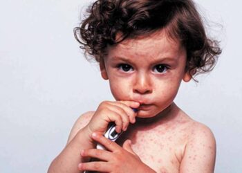 Санврач Алматы сообщил о резком росте заболеваемости корью среди детей