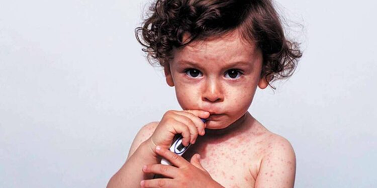 Санврач Алматы сообщил о резком росте заболеваемости корью среди детей