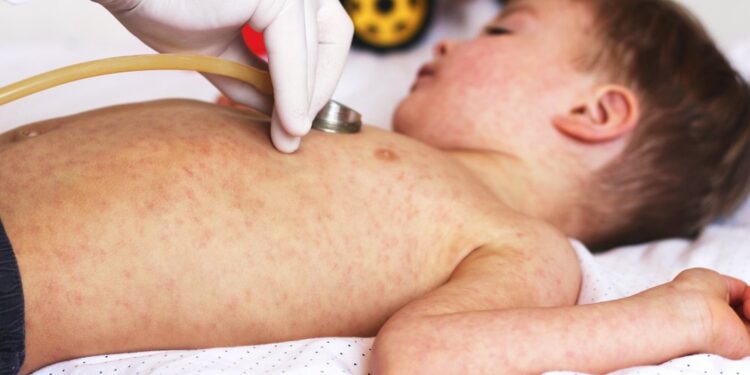 Алматыда қызылша өршіп тұр: 591 адам дертке шалдыққан