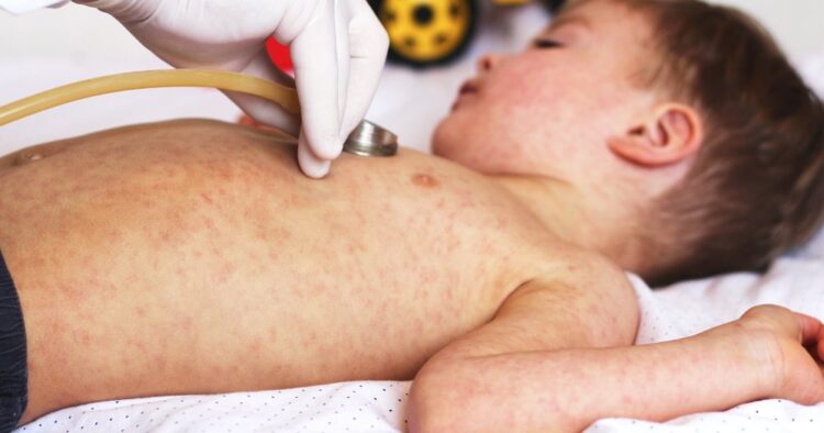 Алматыда қызылша өршіп тұр: 591 адам дертке шалдыққан